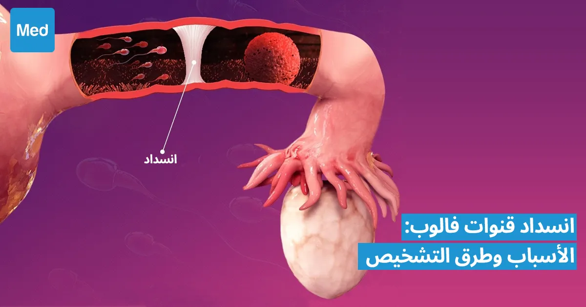 انسداد قنوات فالوب: الأسباب وطرق التشخيص